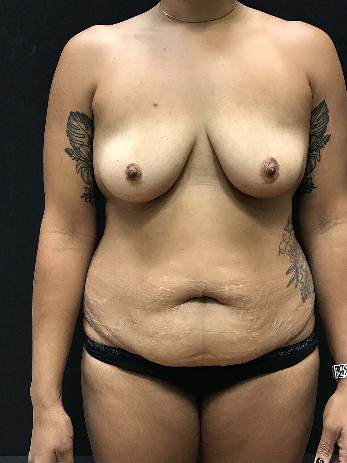 Mommy Makeover Before & After