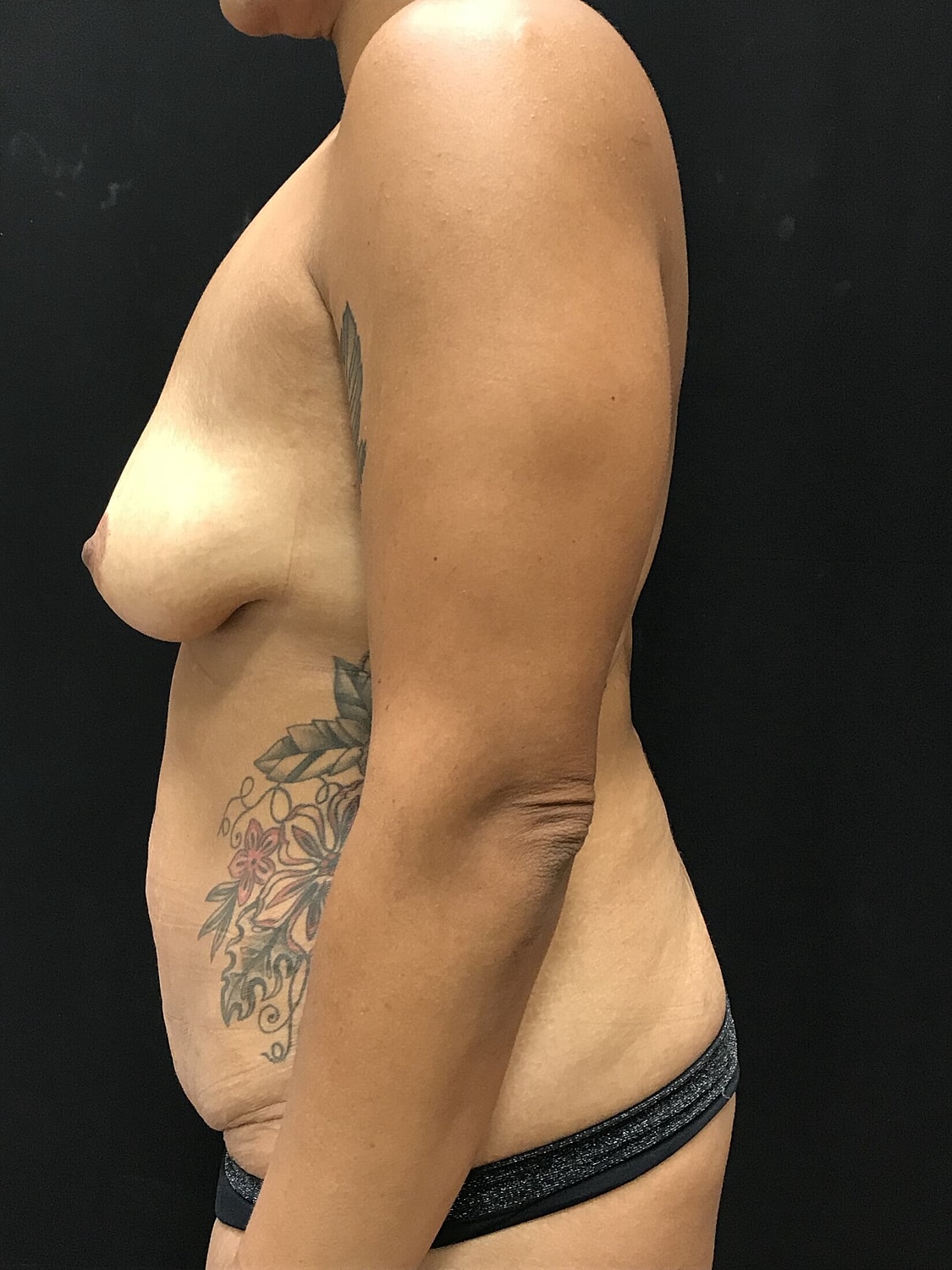 Mommy Makeover Before & After