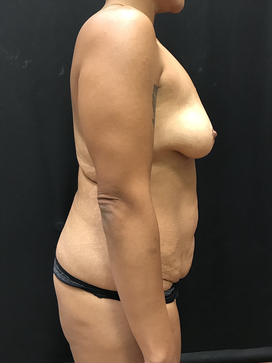 Mommy Makeover Before & After