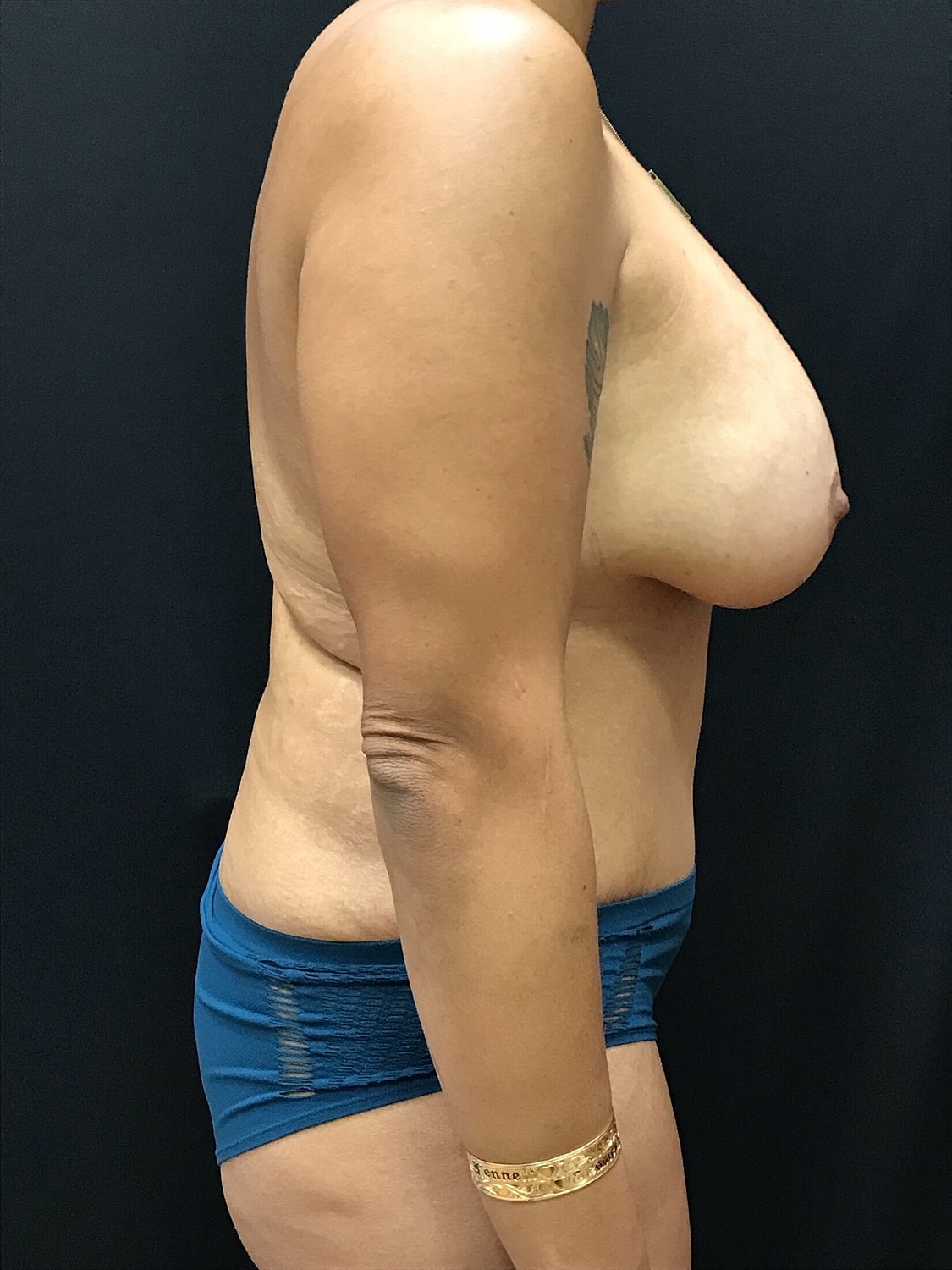 Mommy Makeover Before & After