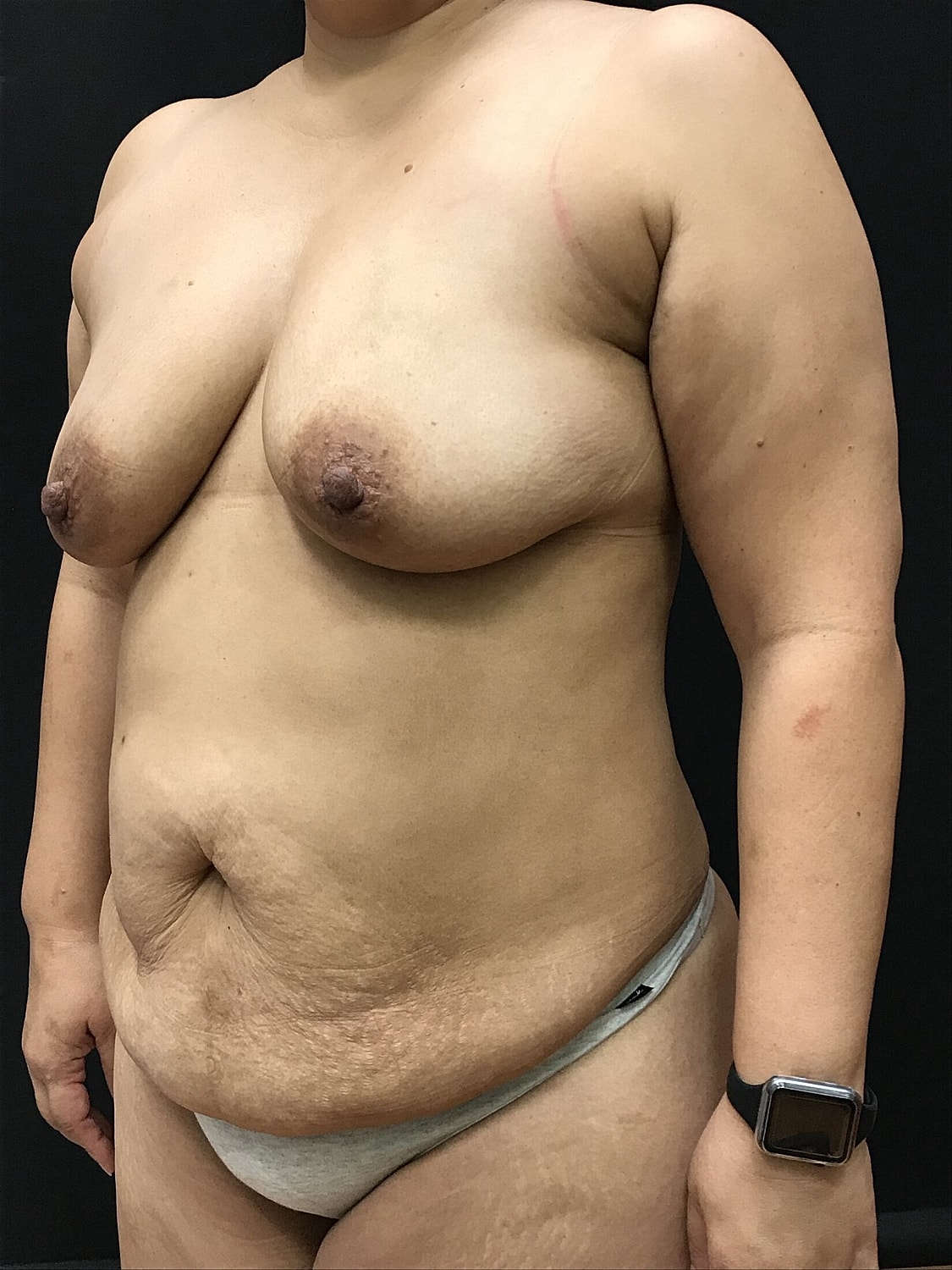 Mommy Makeover Before & After