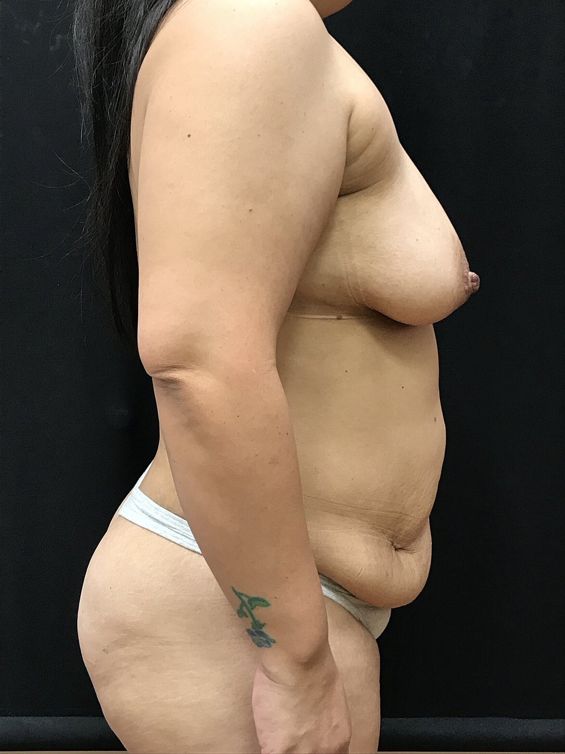 Mommy Makeover Before & After