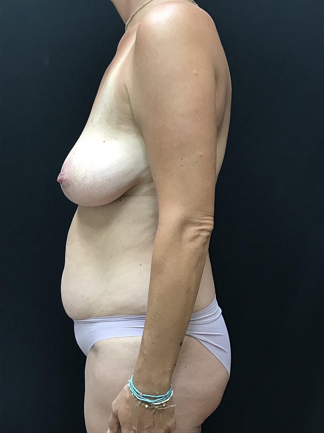 Mommy Makeover Before & After