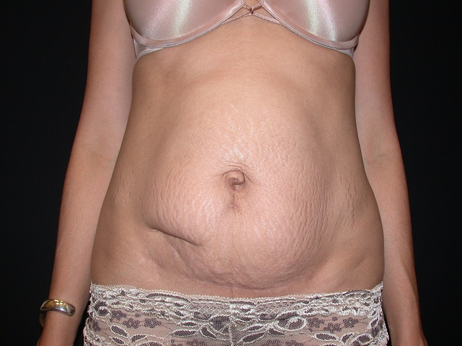 Mommy Makeover Before & After