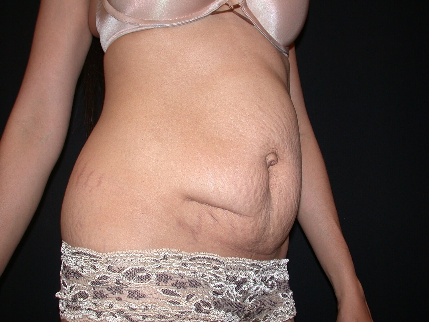 Mommy Makeover Before & After