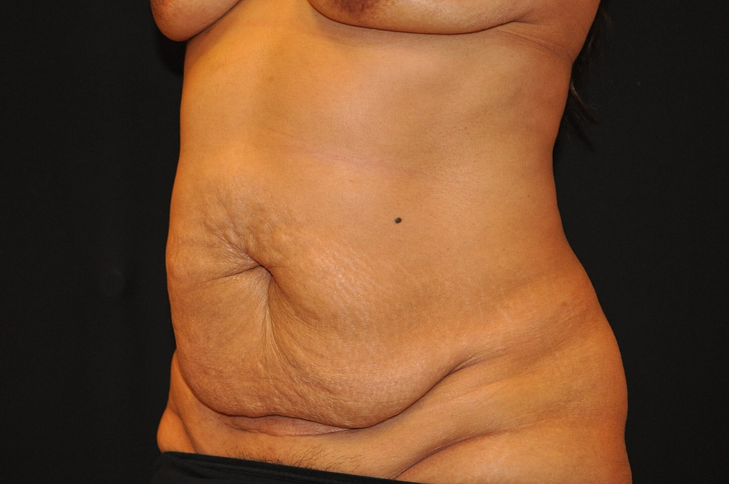 Mommy Makeover Before & After