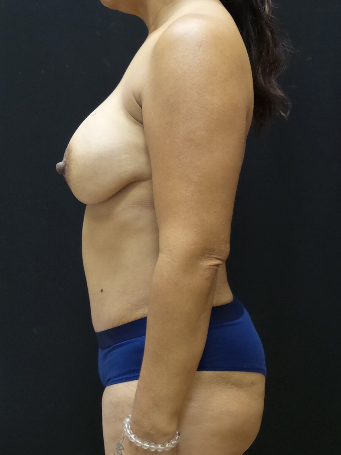 Mommy Makeover Before & After