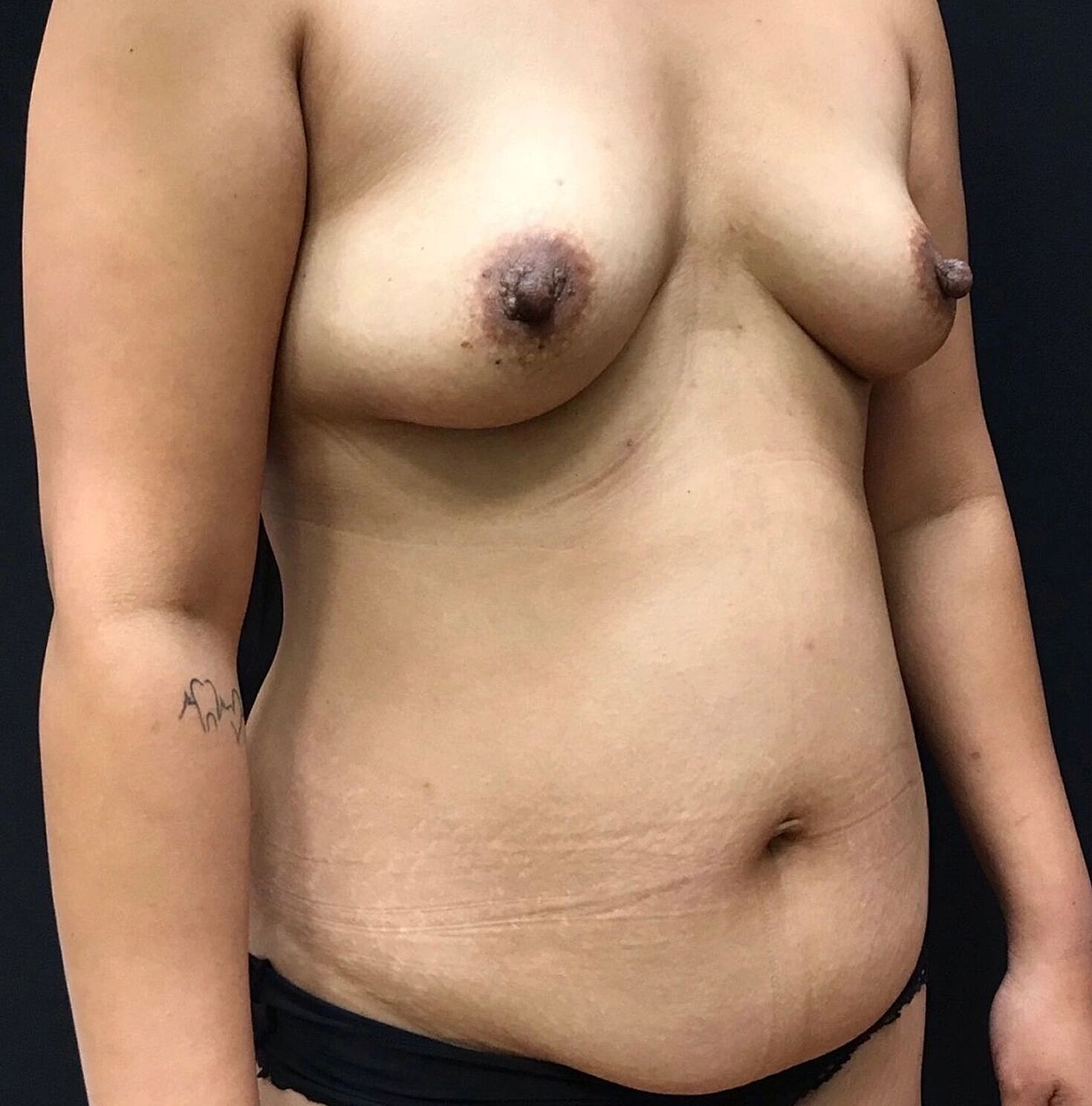 Mommy Makeover Before & After