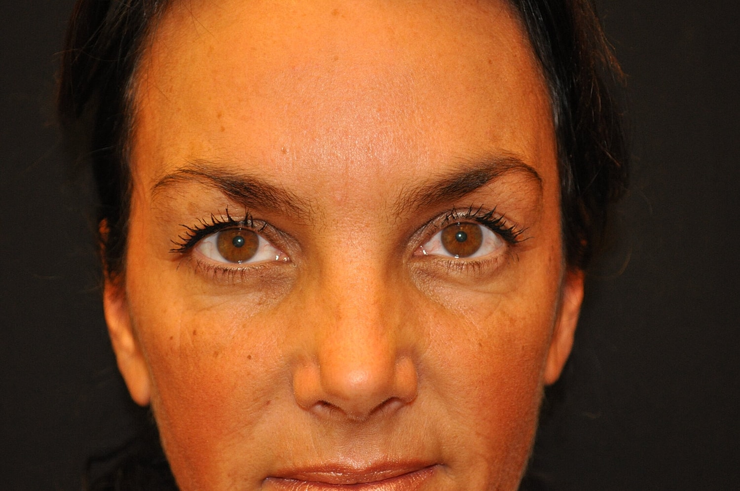 Blephroplasty Before & After