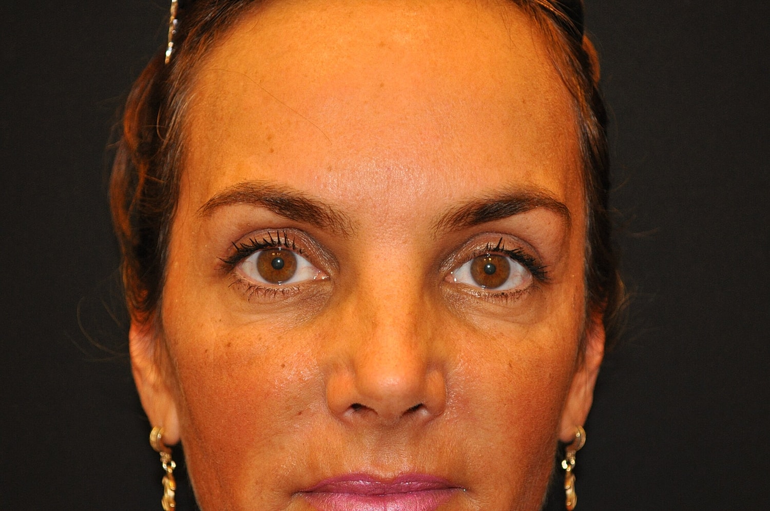 Blephroplasty Before & After