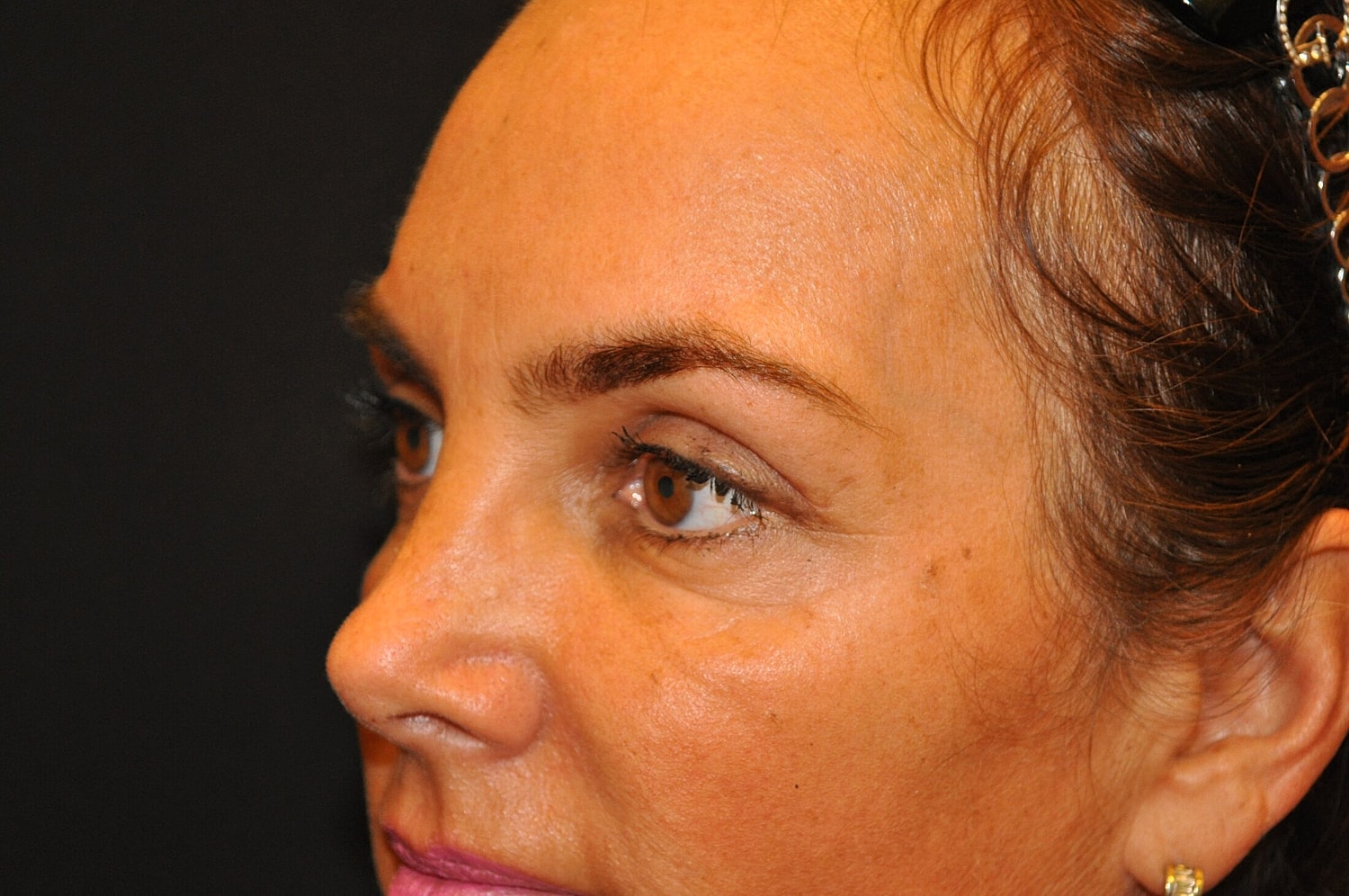 Blephroplasty Before & After