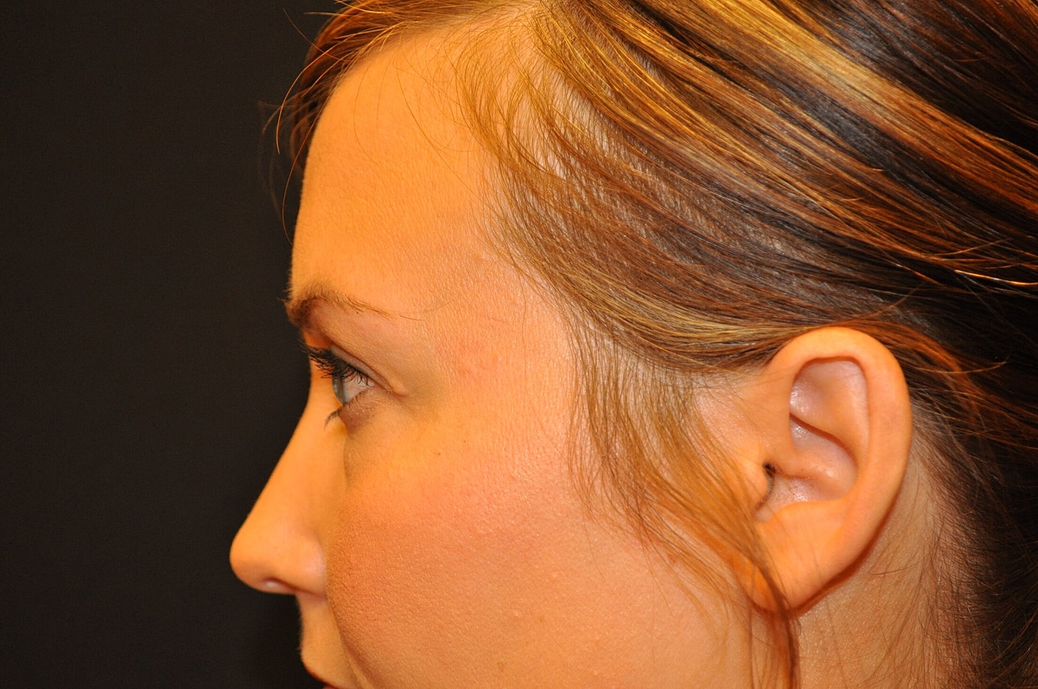 Blephroplasty Before & After