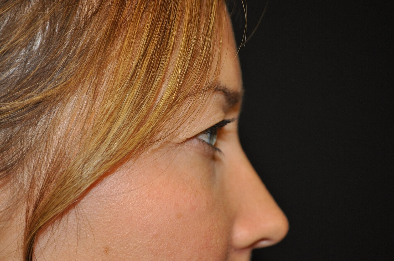 Blephroplasty Before & After