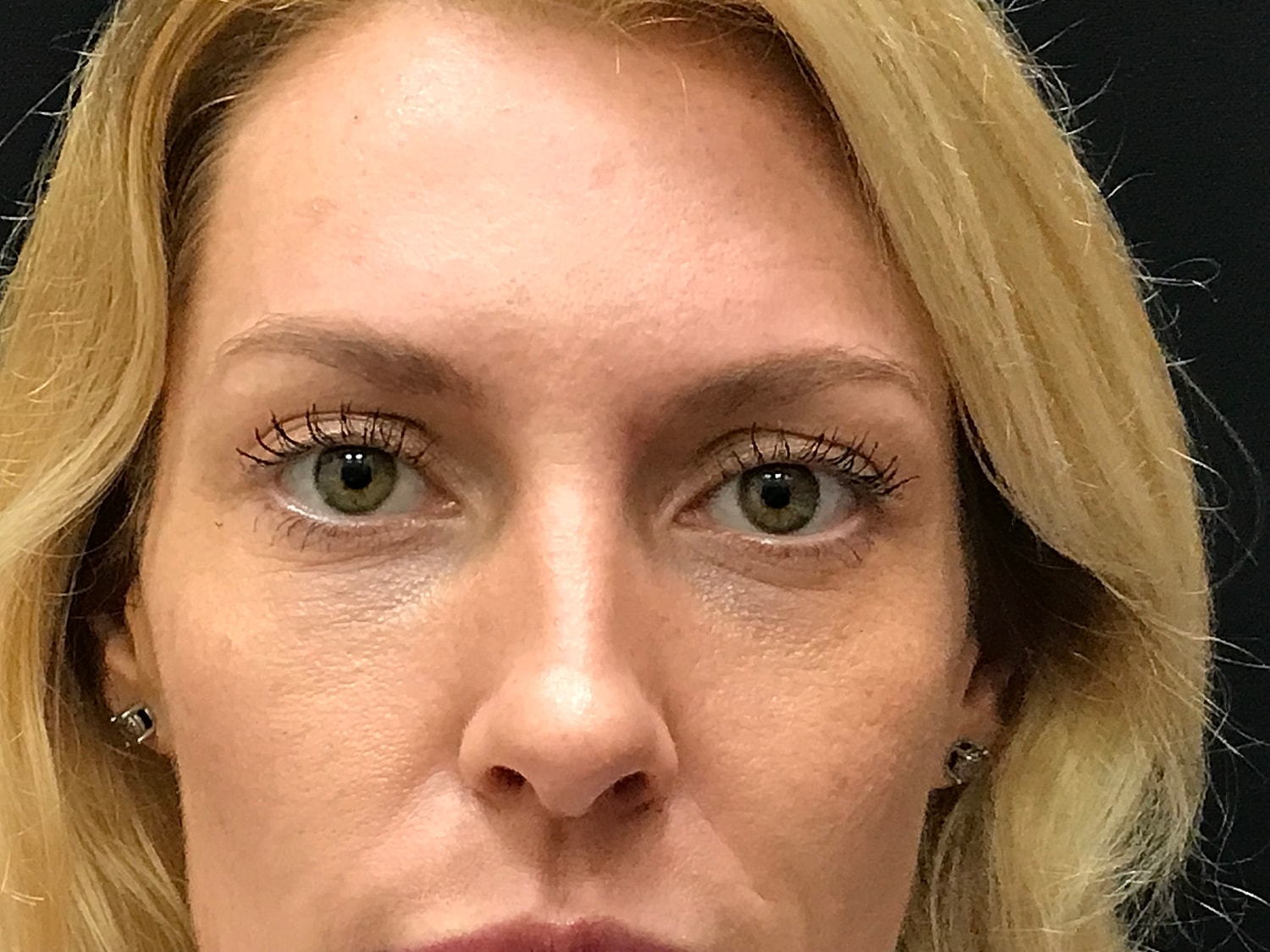 Blephroplasty [.block]Gallery[] Before & After