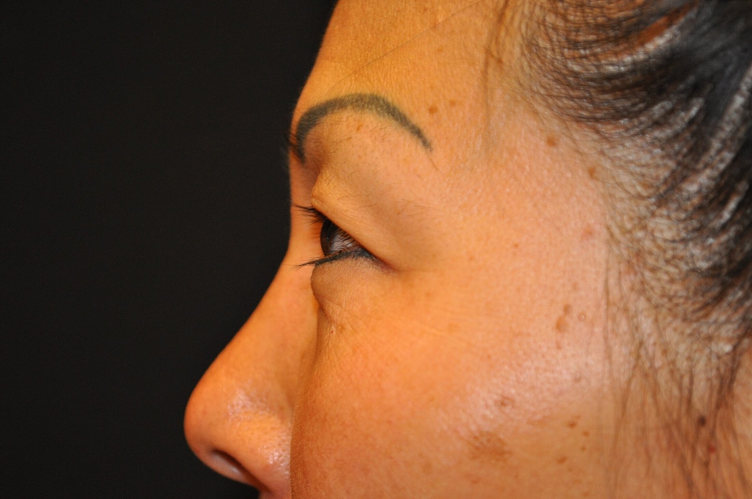 Blephroplasty Before & After