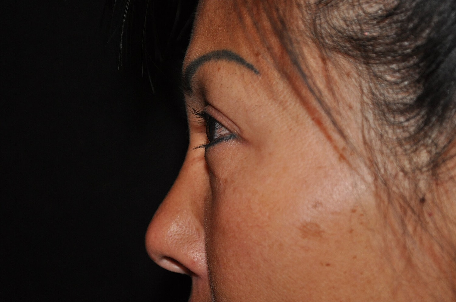 Blephroplasty Before & After