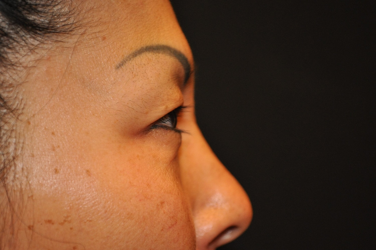 Blephroplasty Before & After