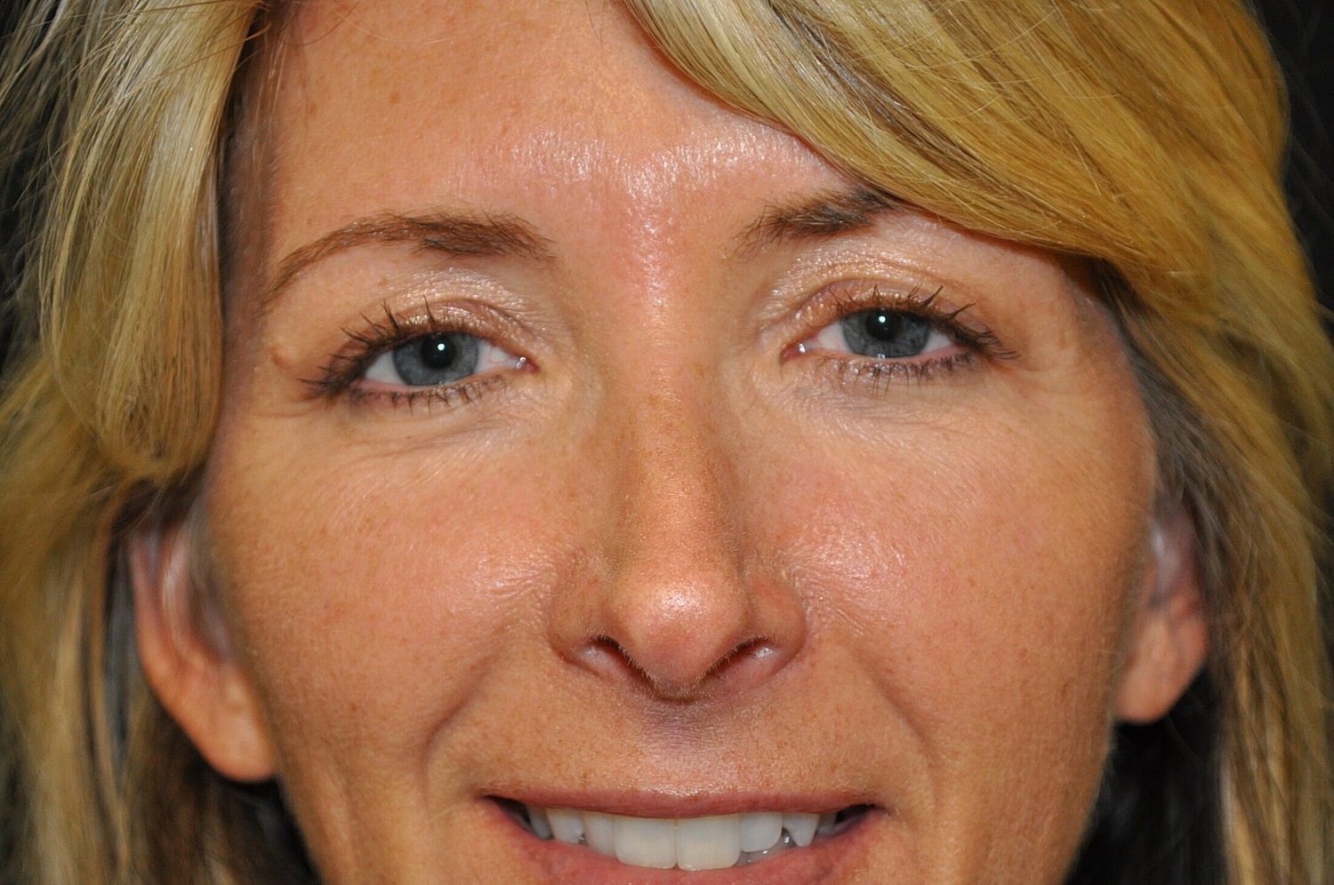 Blephroplasty Before & After