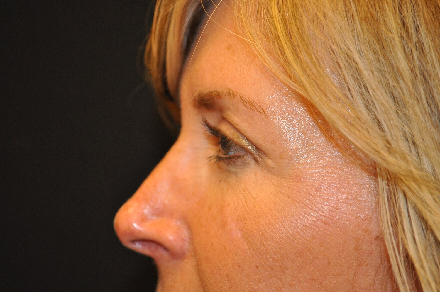 Blephroplasty Before & After