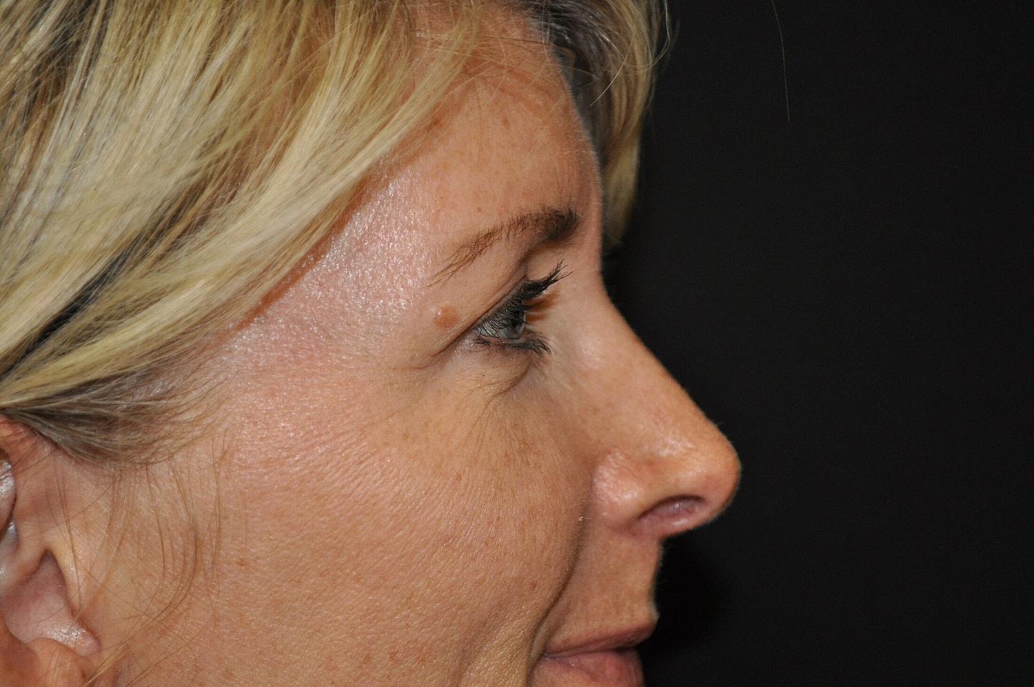 Blephroplasty Before & After