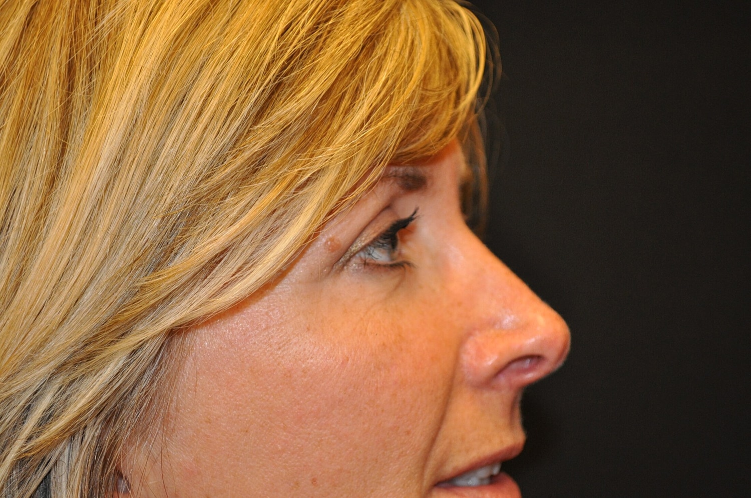 Blephroplasty Before & After