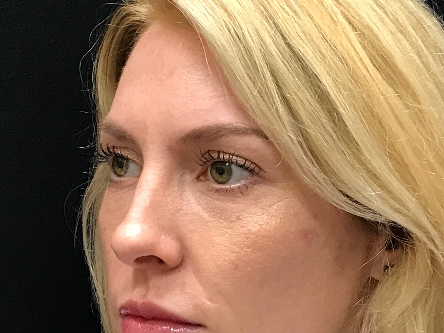 Blephroplasty [.block]Gallery[] Before & After