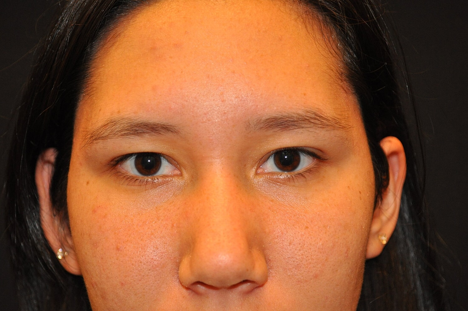 Blephroplasty Before & After