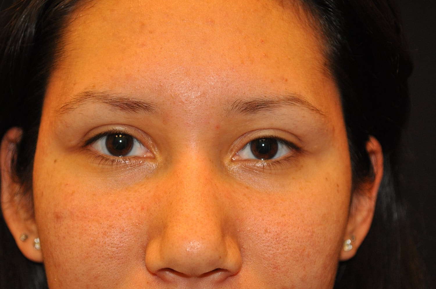 Blephroplasty Before & After