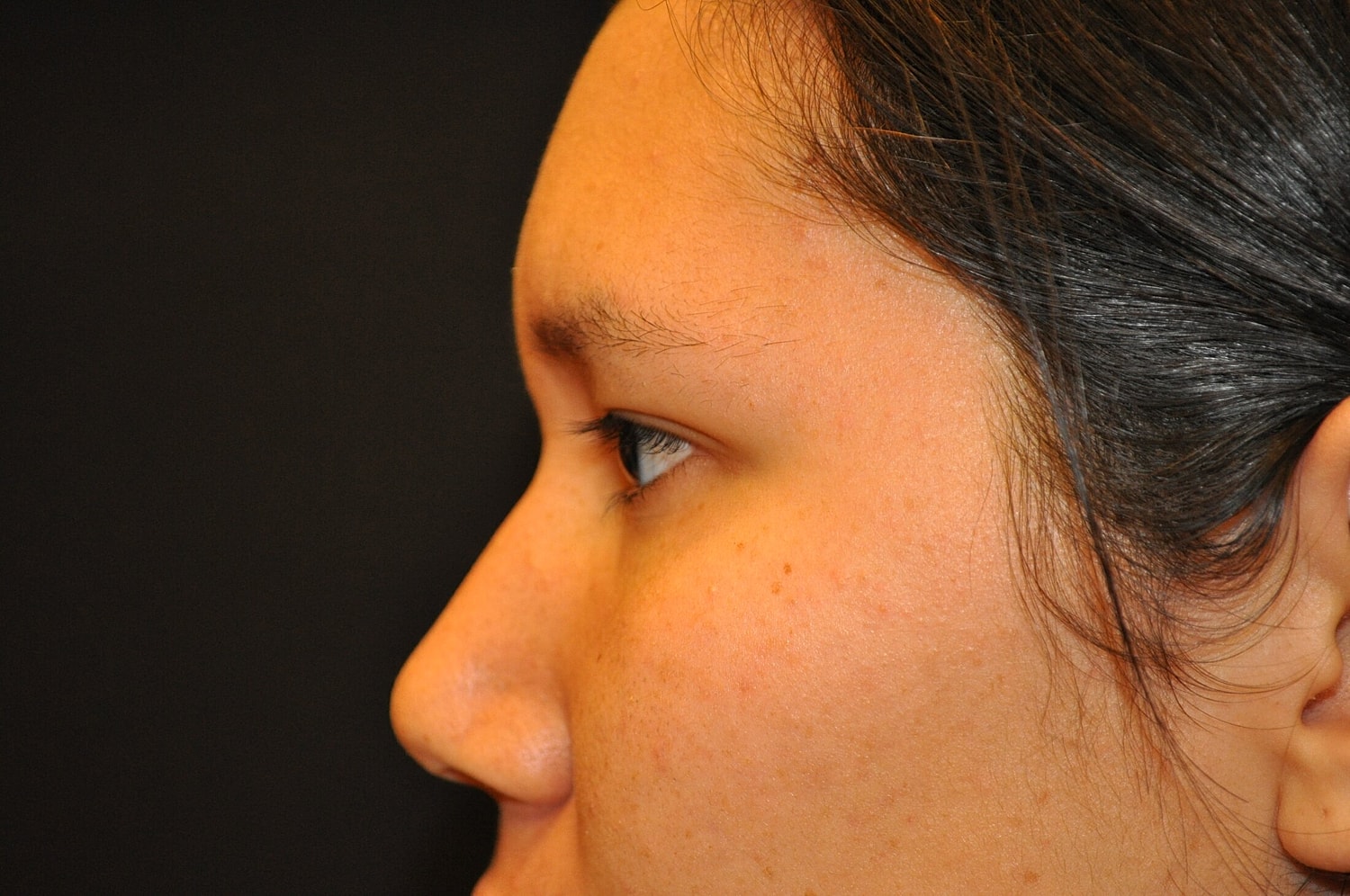 Blephroplasty Before & After