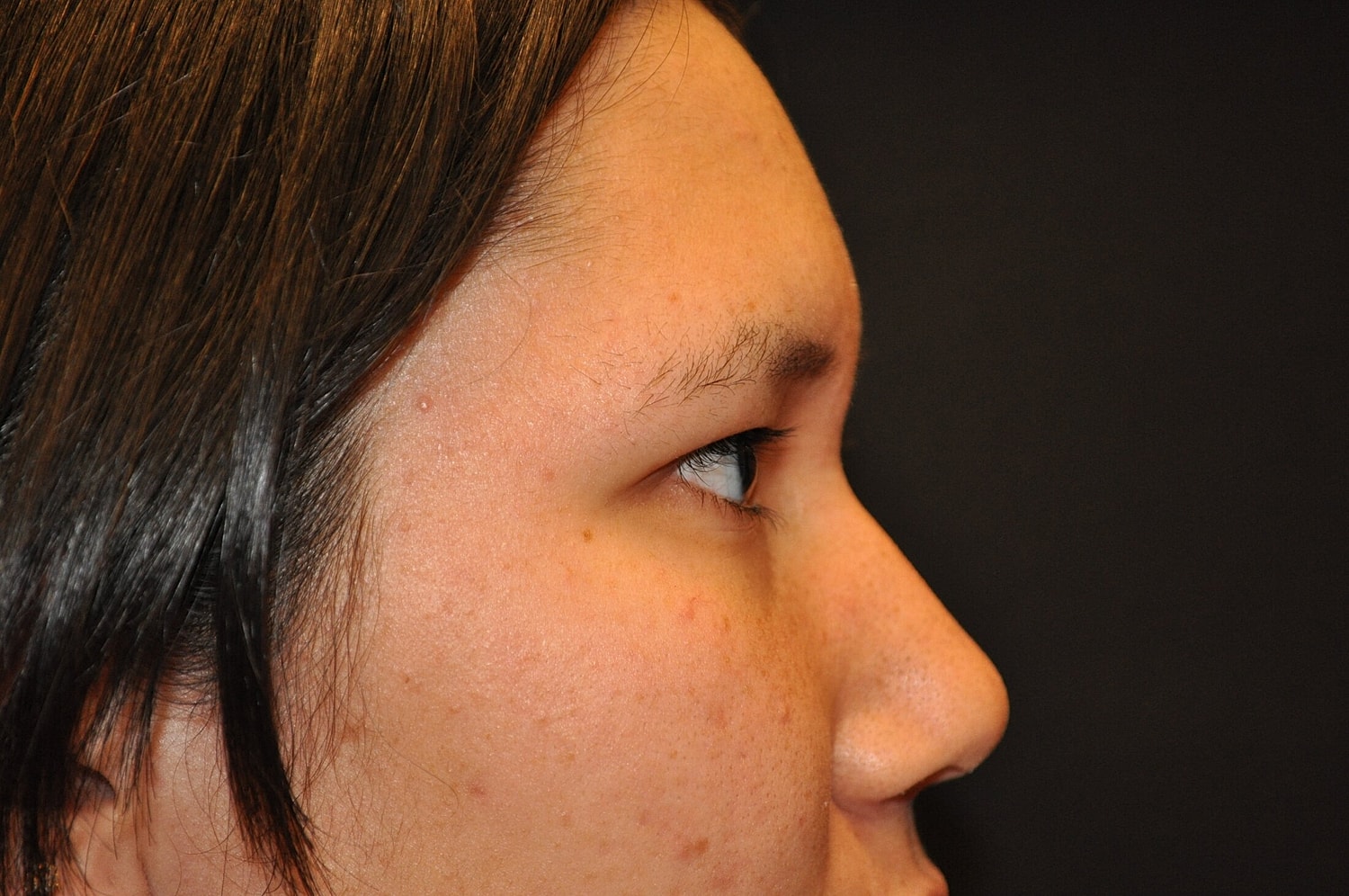 Blephroplasty Before & After