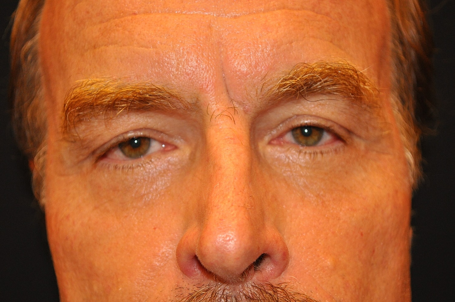 Blephroplasty Before & After