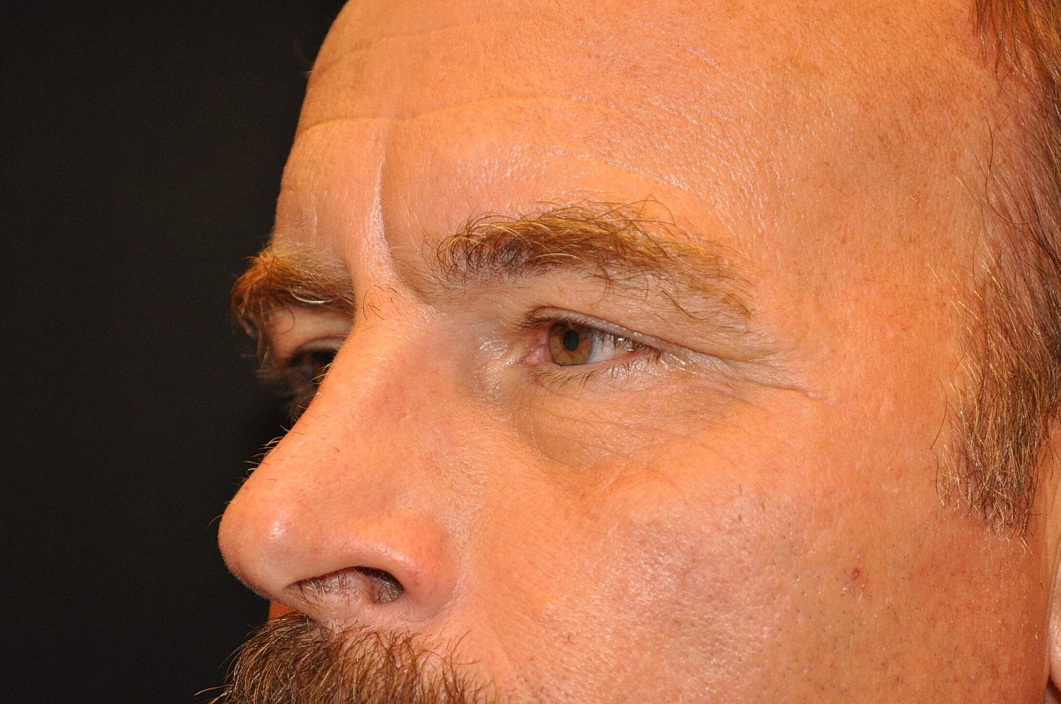 Blephroplasty Before & After