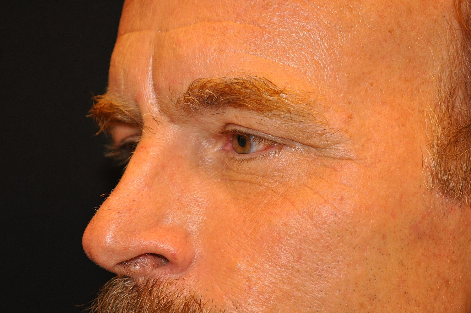 Blephroplasty Before & After