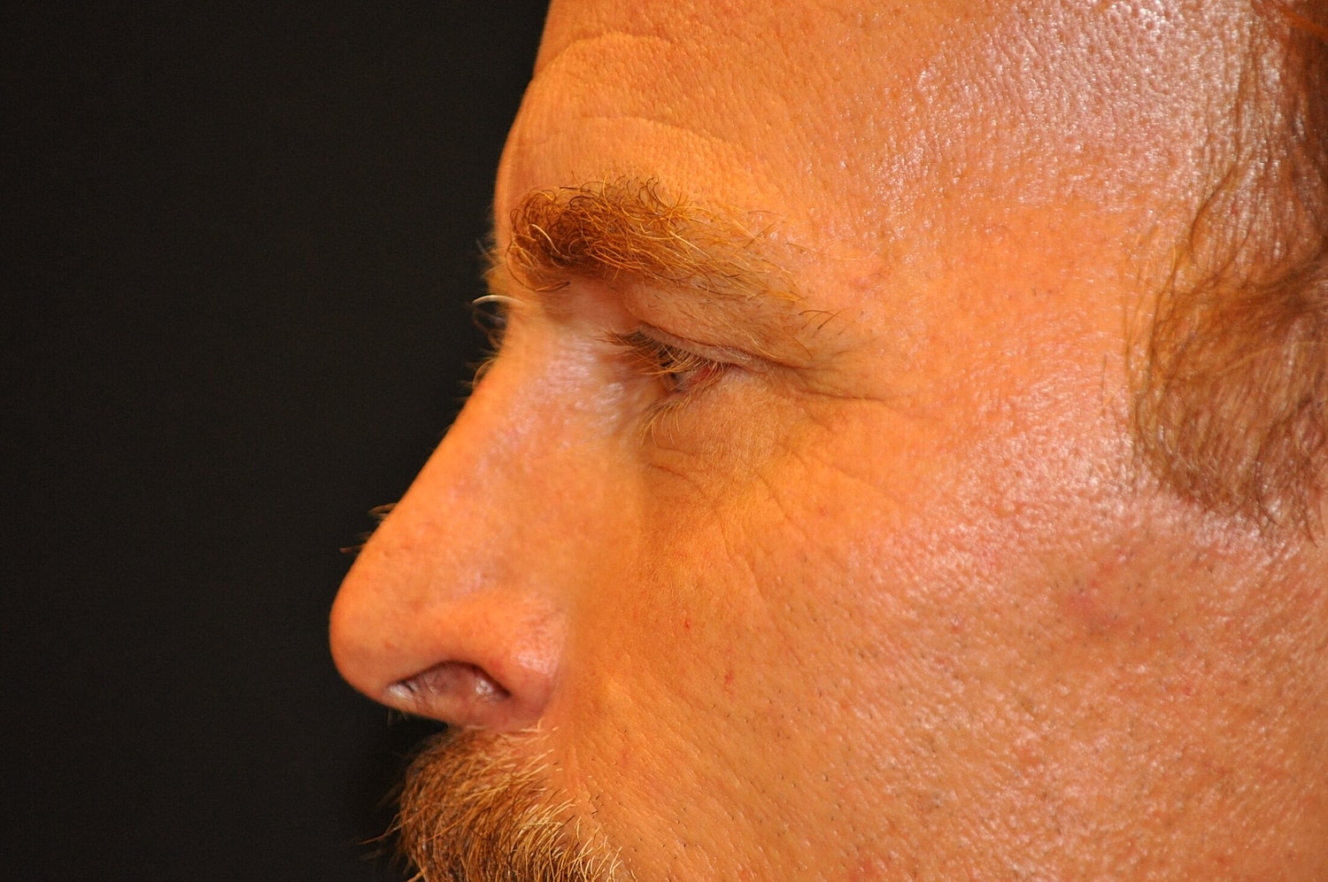 Blephroplasty Before & After