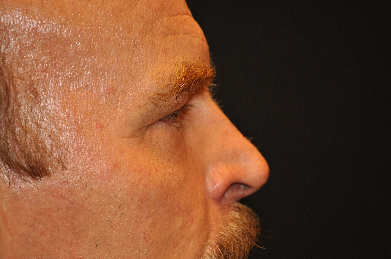 Blephroplasty Before & After