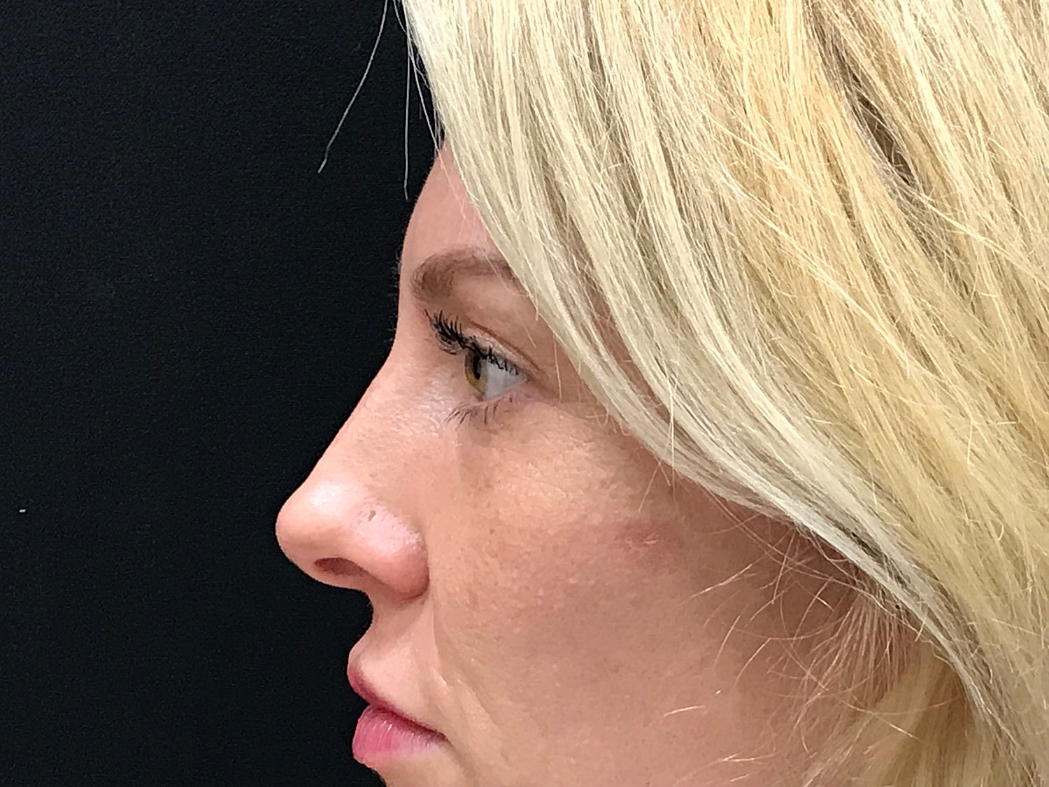 Blephroplasty [.block]Gallery[] Before & After