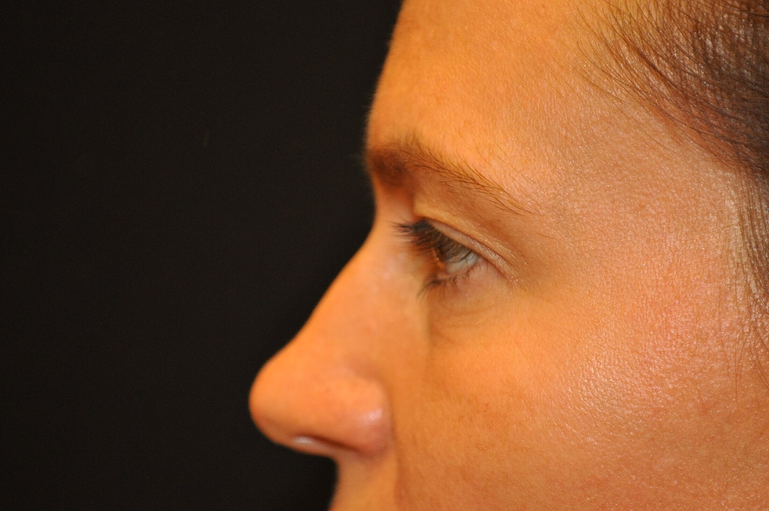 Blephroplasty Before & After