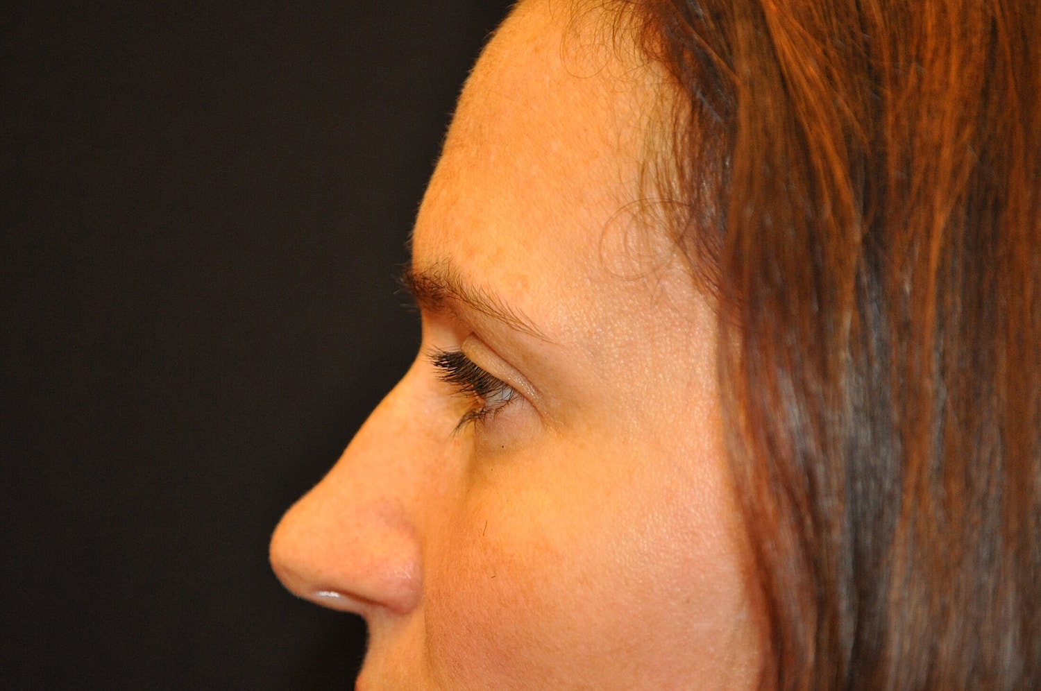 Blephroplasty Before & After