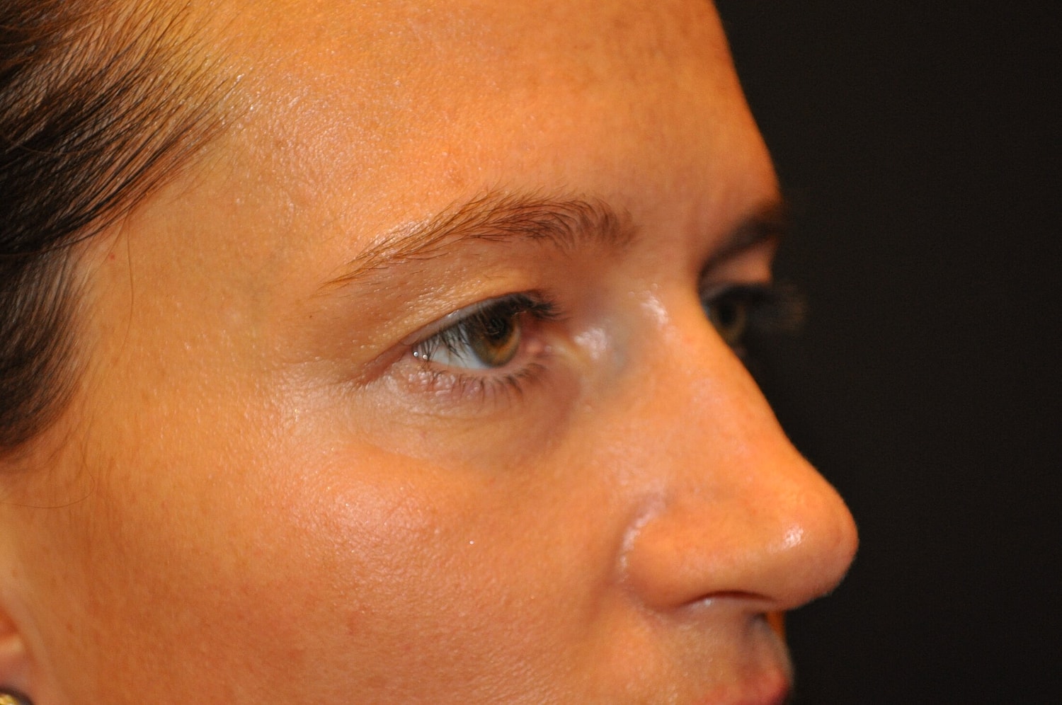 Blephroplasty Before & After