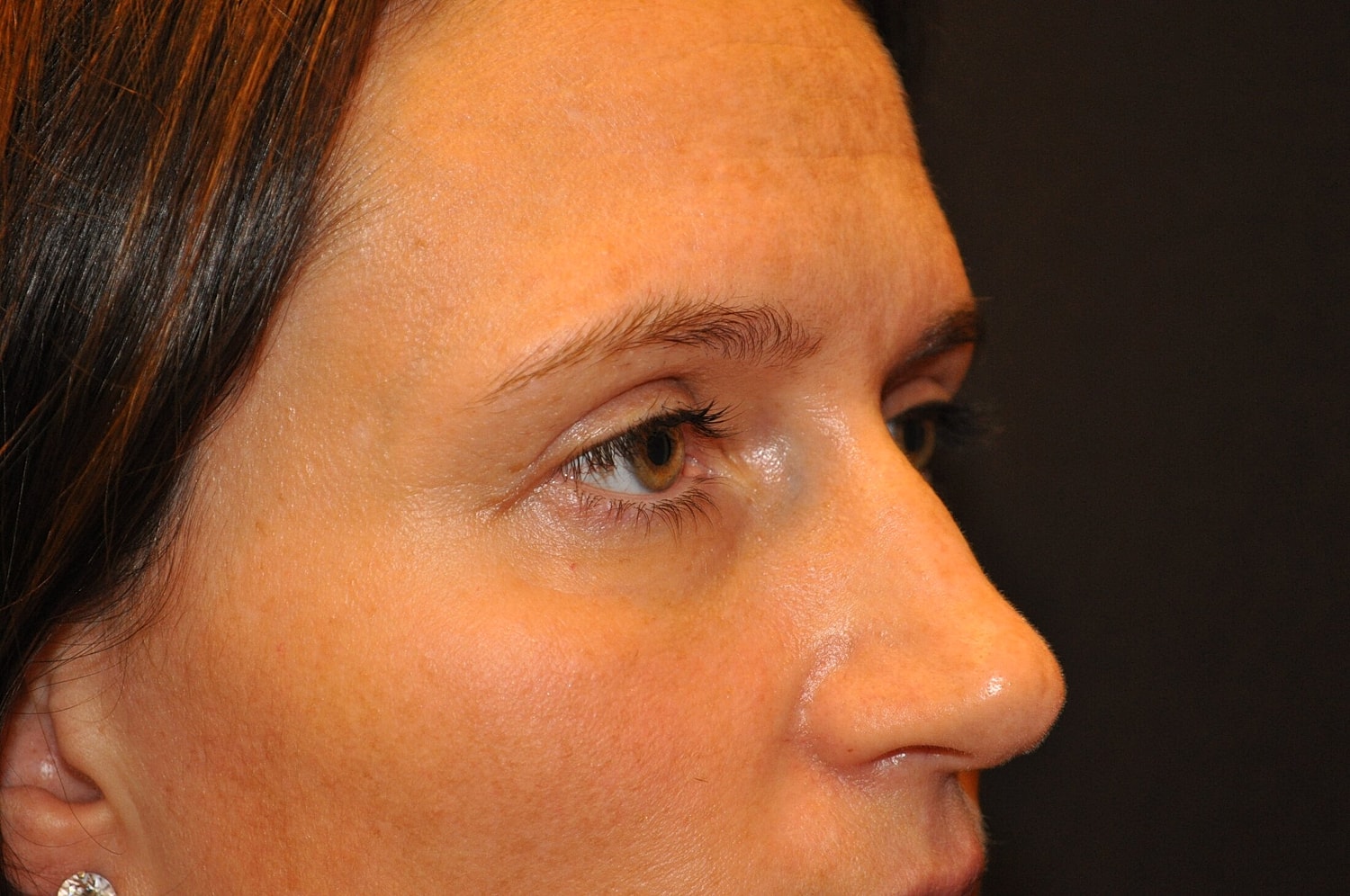 Blephroplasty Before & After