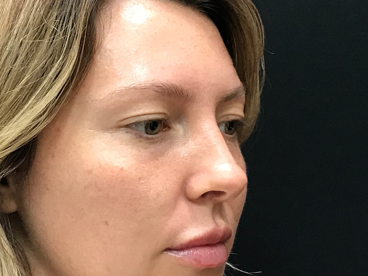 Blephroplasty [.block]Gallery[] Before & After