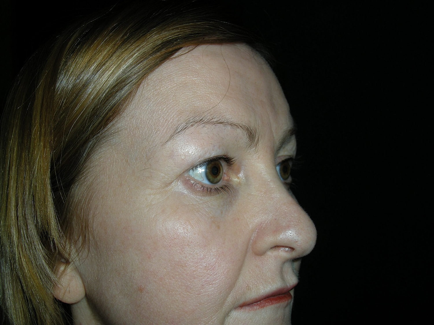 Blephroplasty Before & After