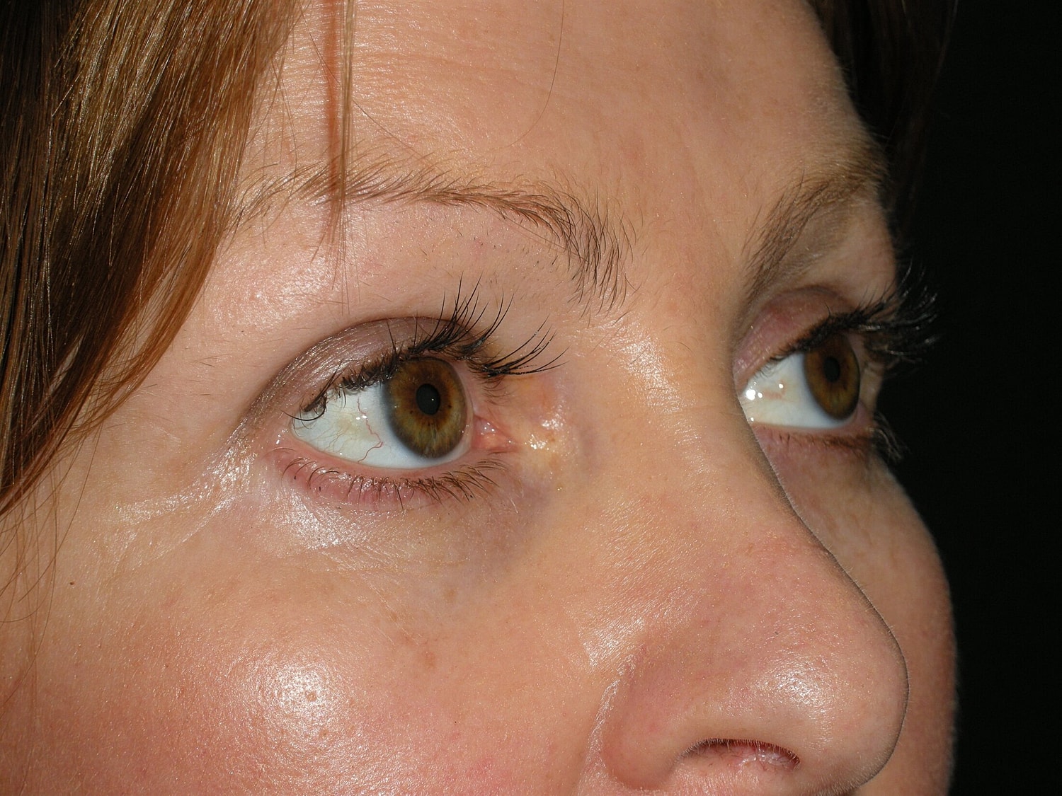 Blephroplasty Before & After