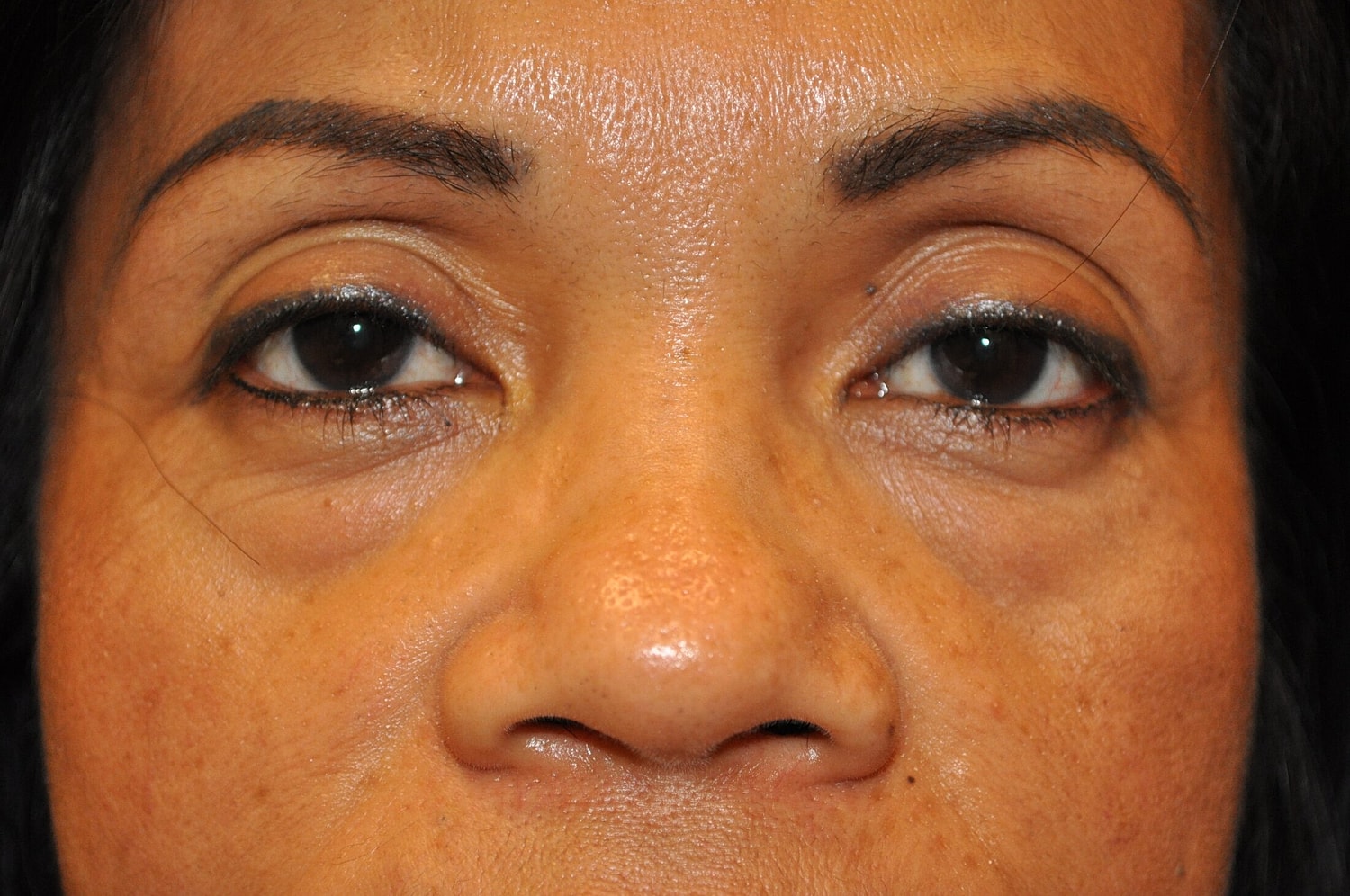 Blephroplasty Before & After