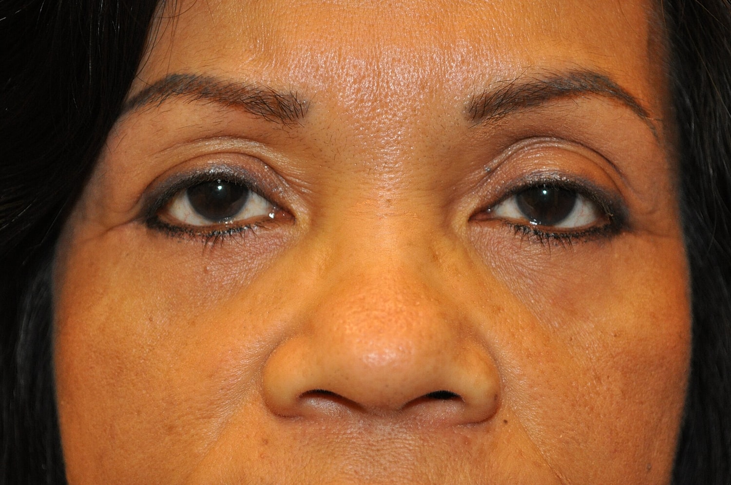 Blephroplasty Before & After