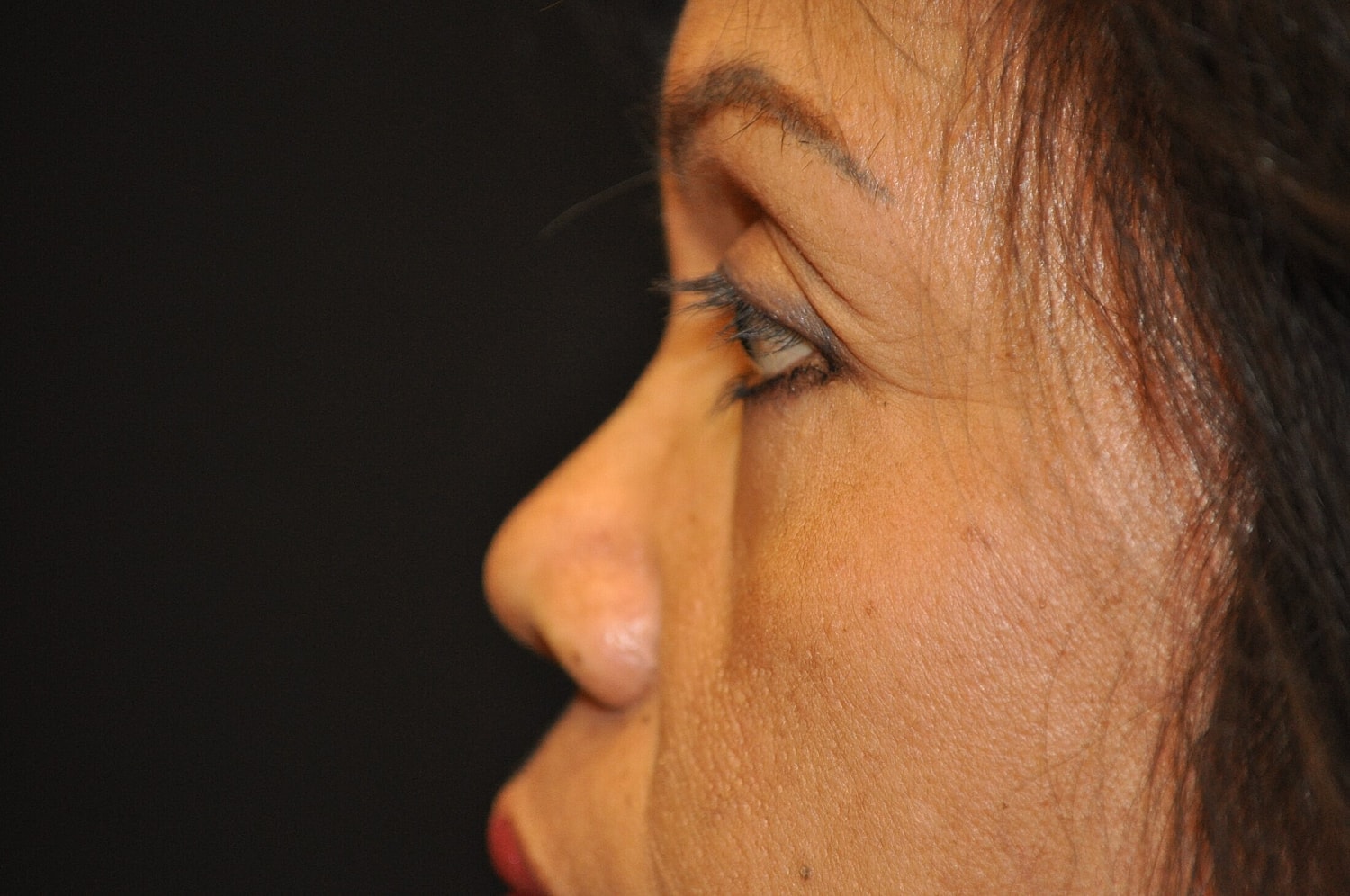 Blephroplasty Before & After