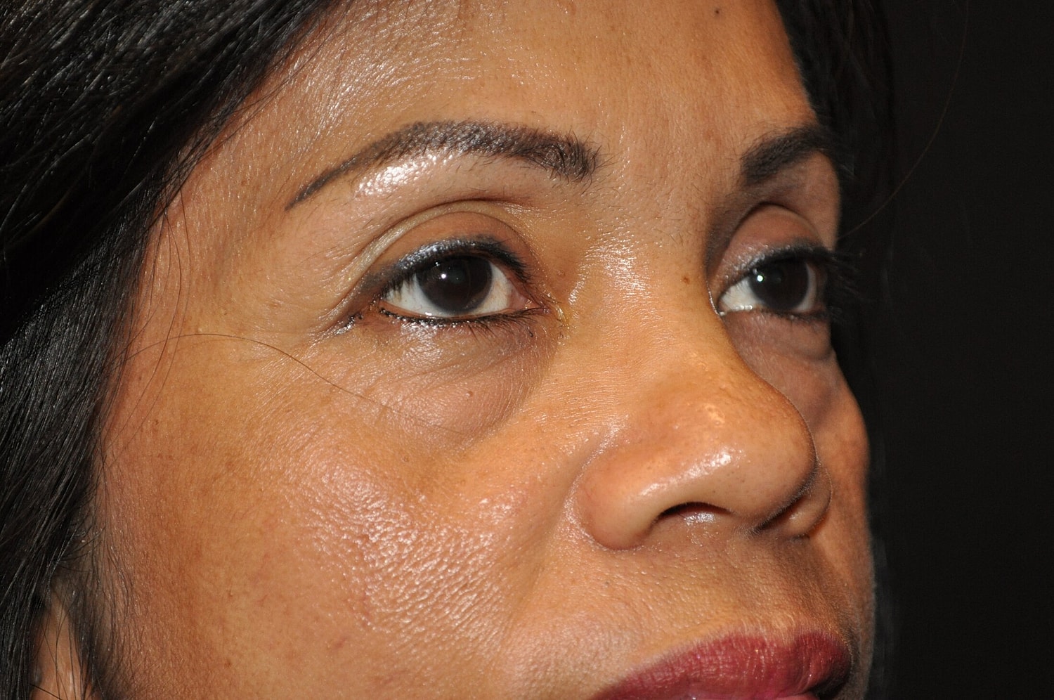 Blephroplasty Before & After