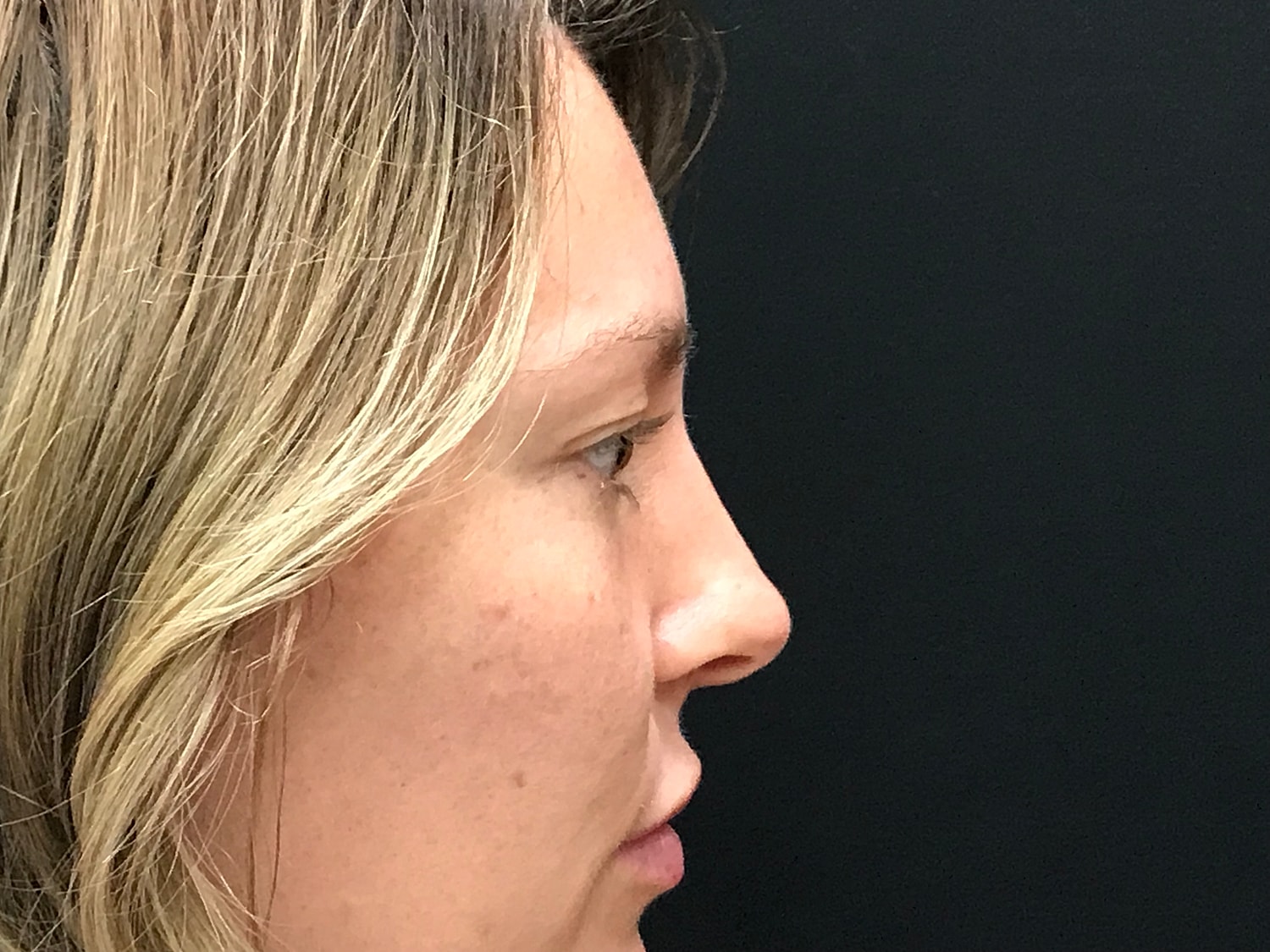 Blephroplasty [.block]Gallery[] Before & After