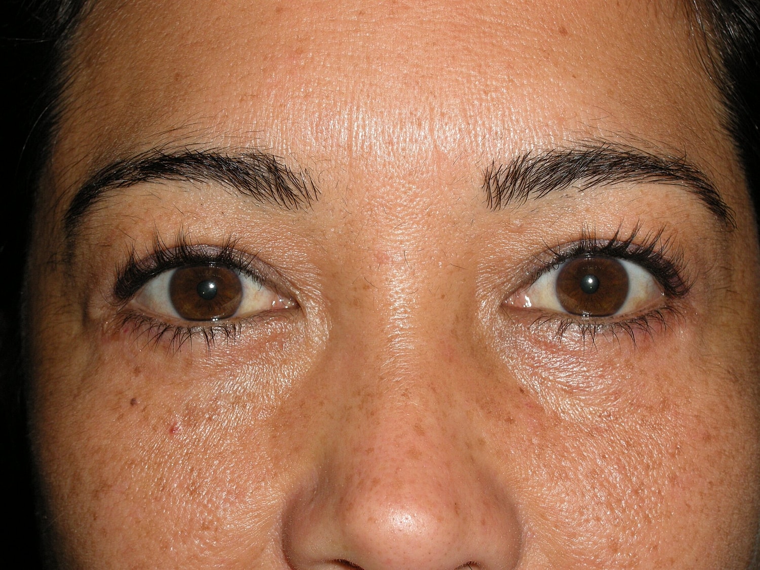 Blephroplasty Before & After