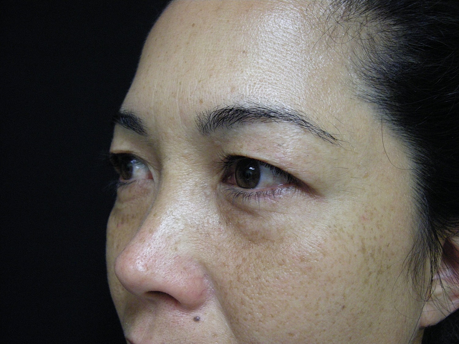 Blephroplasty Before & After